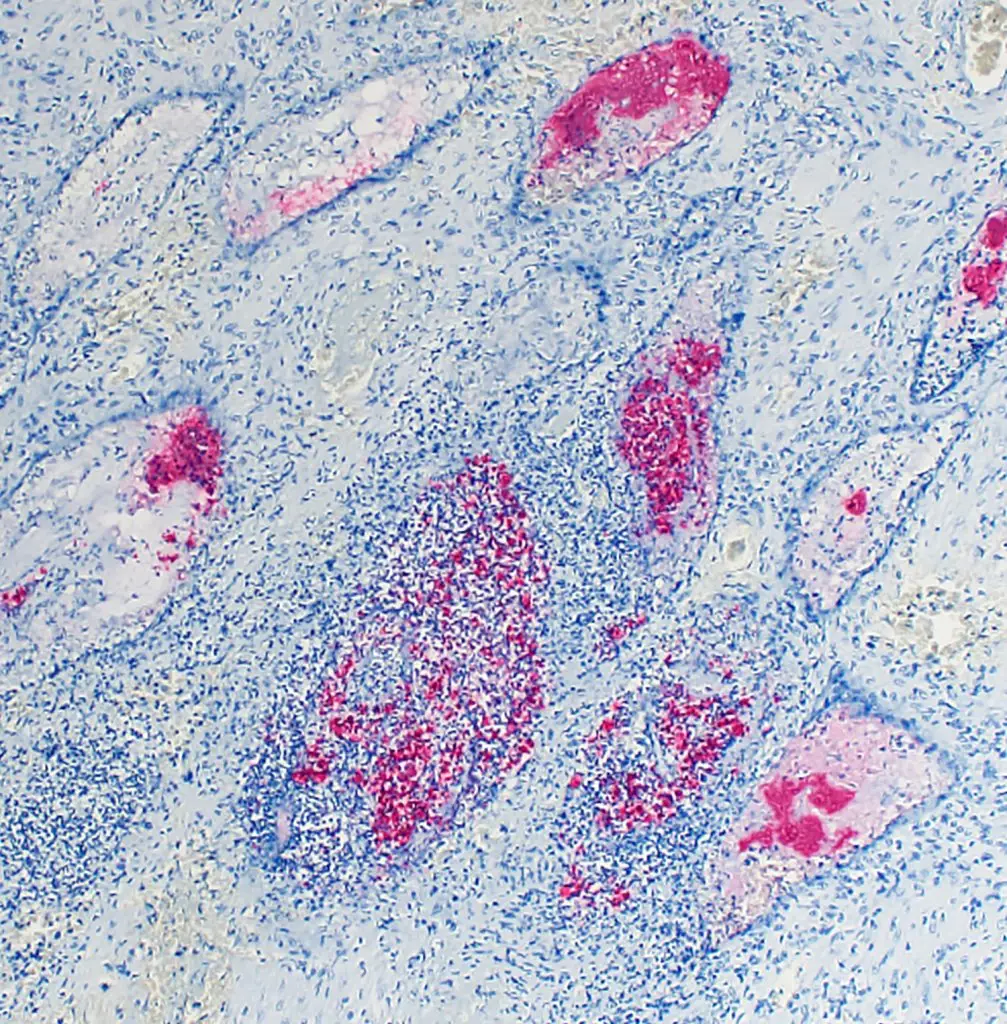 Microscopic image showing stained tissue used to detect bacteria that cause brucellosis